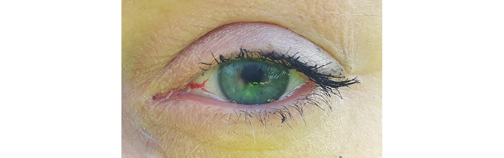 Left eye foggy lens