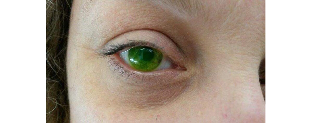 Right eye dye