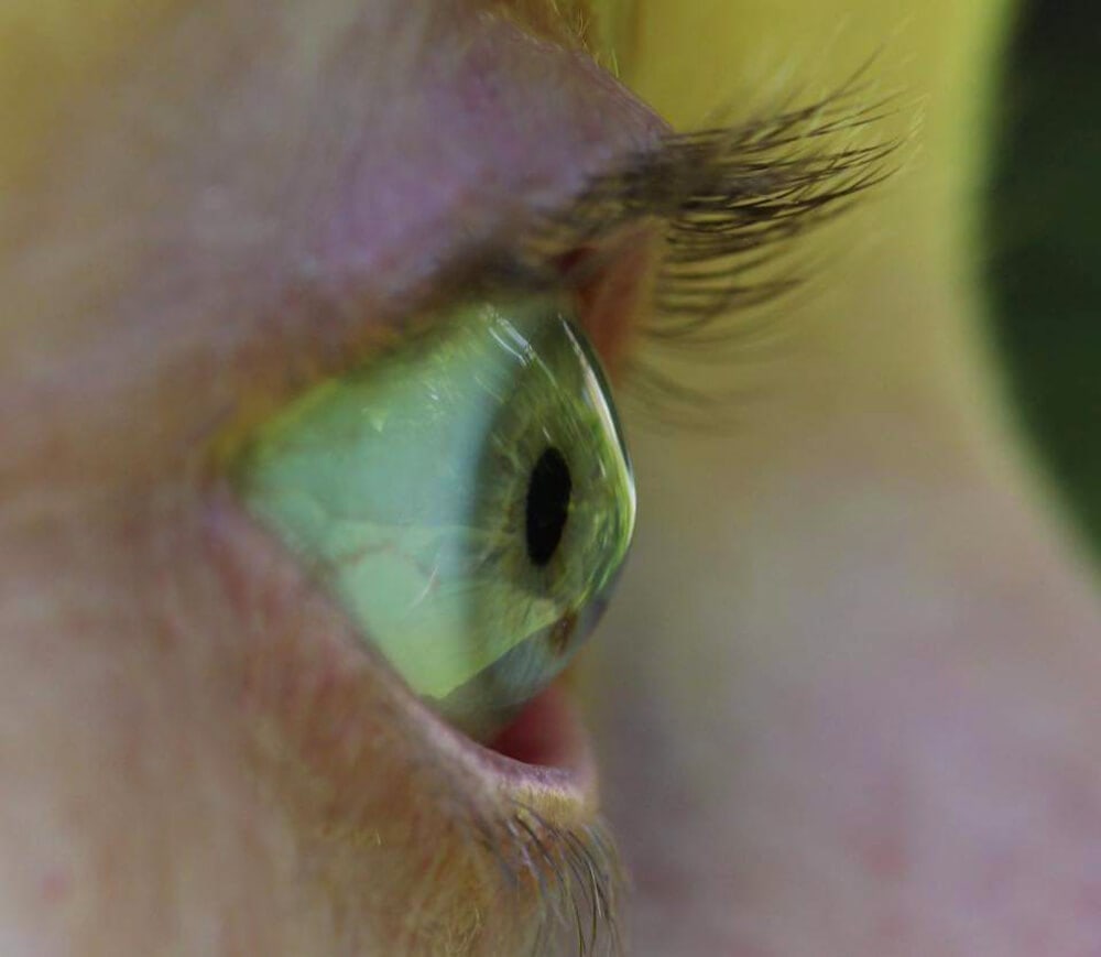 Right eye pre transplant keratoconus
