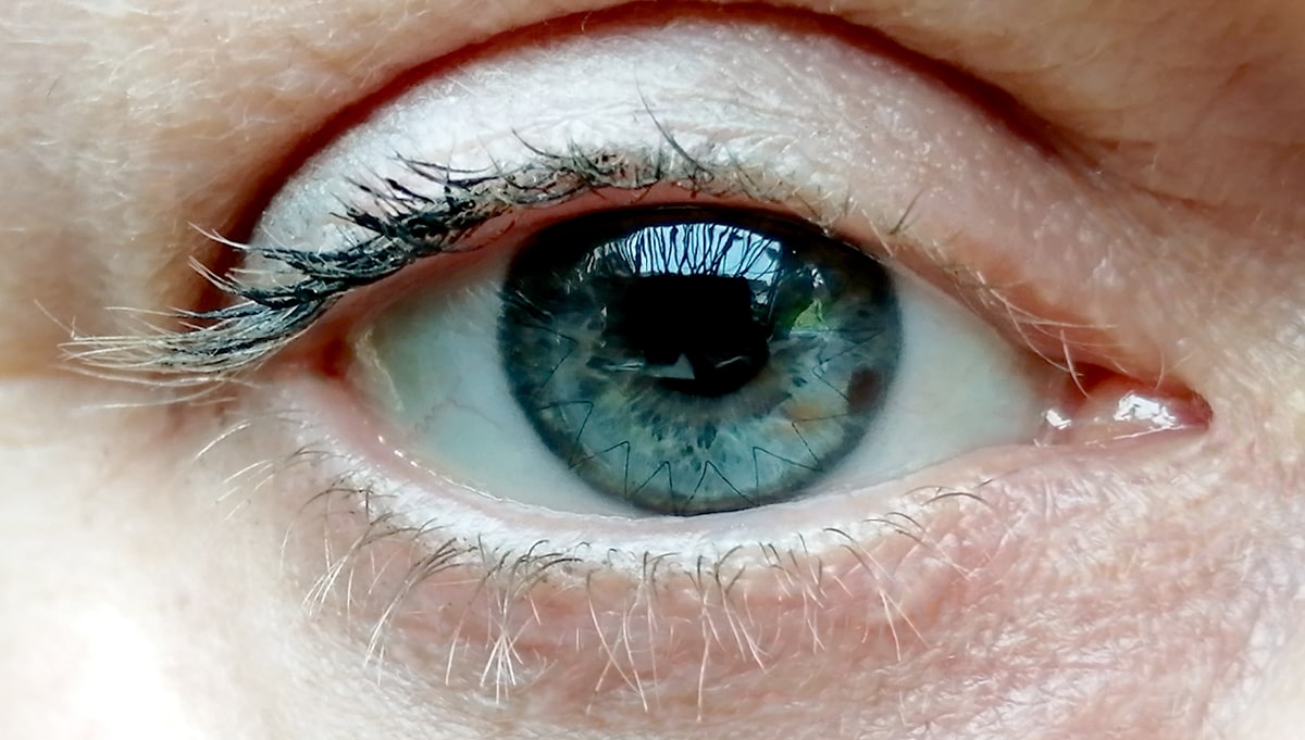 Close up photo of healthy corneal transplant eye with stitches