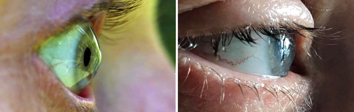 Left photo shows pre op keratoconus coney eye. Right photo shows post corneal transplant rounded profile.