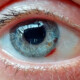 Close up photo on eye with stitches 2 years after transplant and remains of subconjunctival haemorrhage
