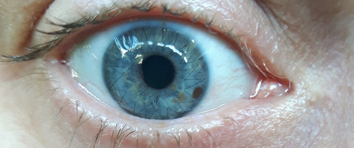 Day 8 - one week old - Corneal transplant 28th June 2019