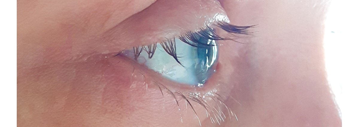 Full Cornea Transplant in profile healing Day 9