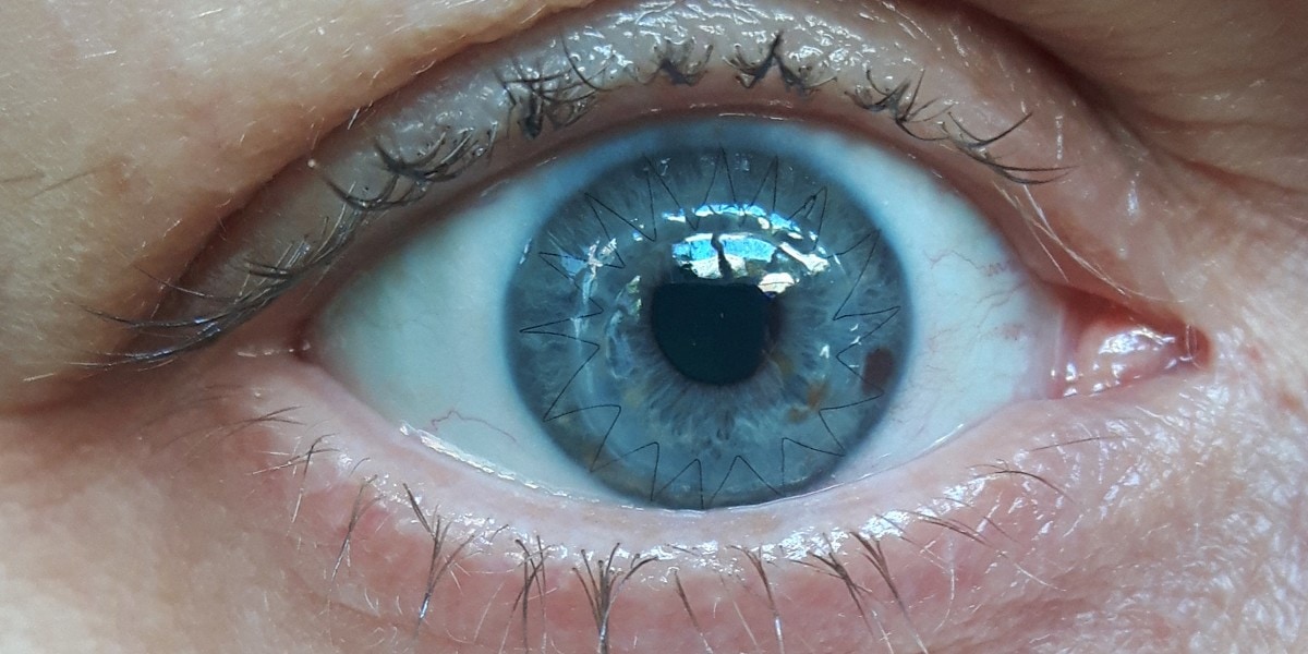 Full Corneal Transplant day 7 - you can see the continuous running stitch all the way around the cornea