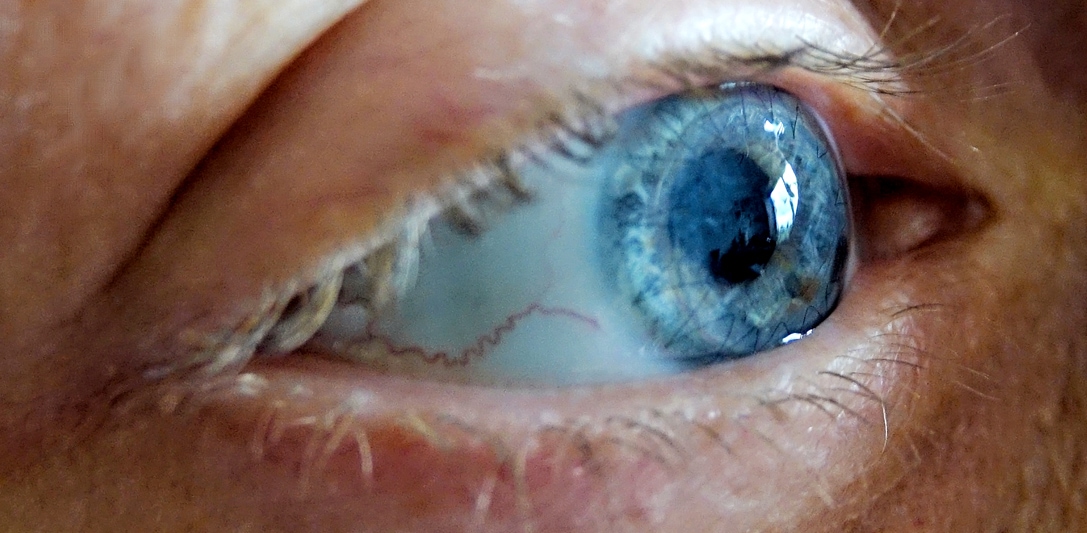 PK full corneal transplant day 10 - trying to get a different view!