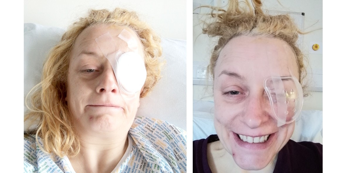 Putting on a brave face 2 photos of me with eye patch and 'grins'