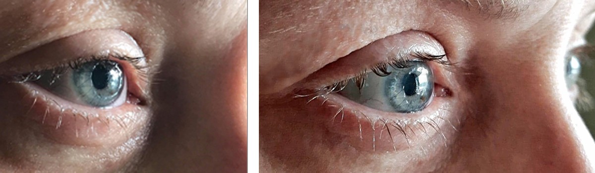 Corneal Transplant day 3 and day 9 comparison 29th June 2019