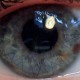 Eye photo - corneal transplant - 4 months on with stitches