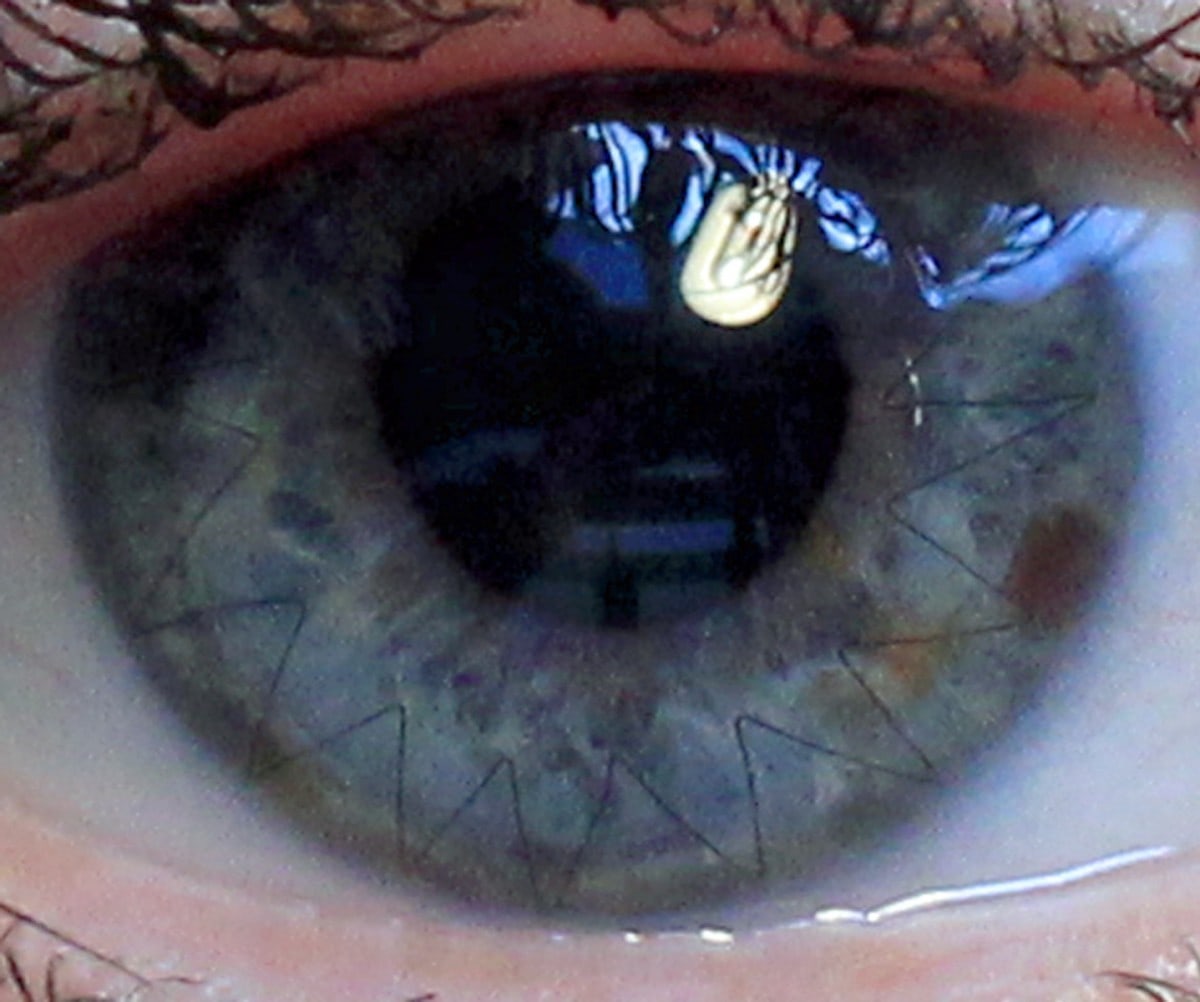 Cornea transplant photo of eye 4 months