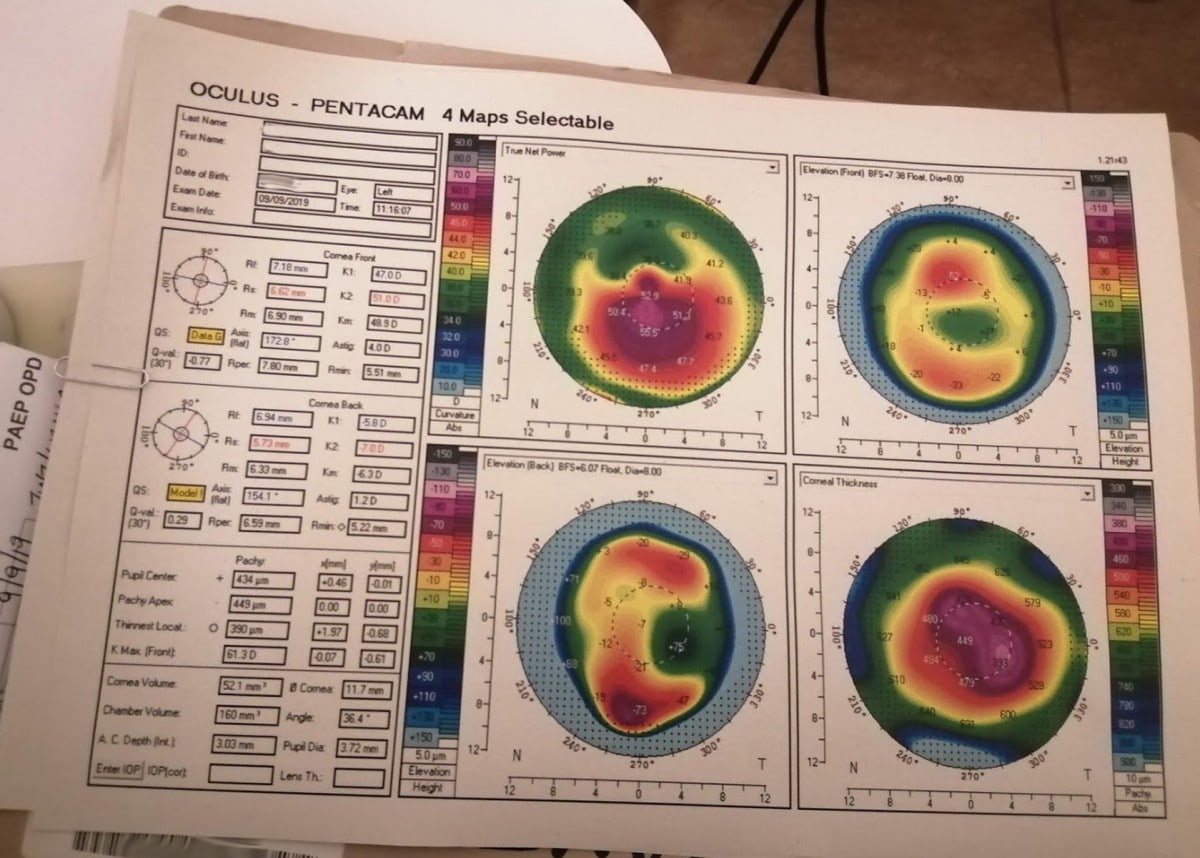 Left eye topography chart from 9th September 2019