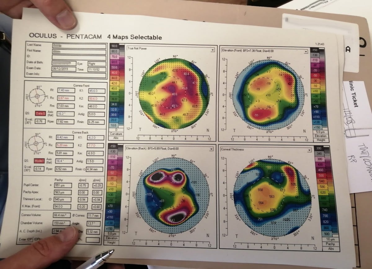 Right eye 2 month post transplant Topography