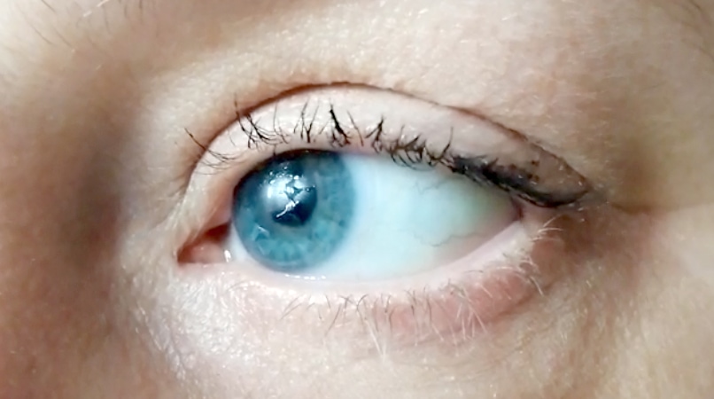 Photo showing my eye with tears that are pooling on my contact lens