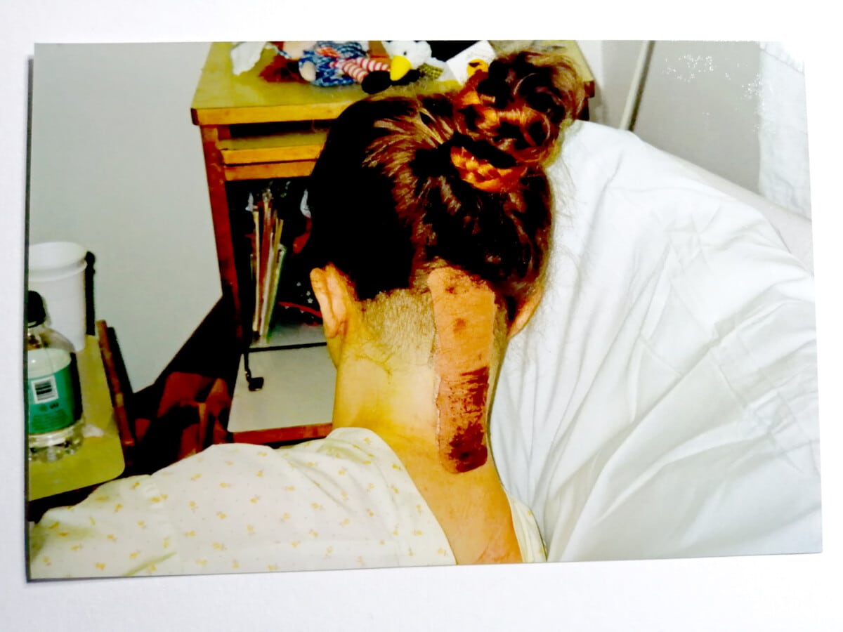 Photo showing back of head in hospital bed with a big plaster on neck covering the wound following haemangiobalstoma brain tumour surgery 1998