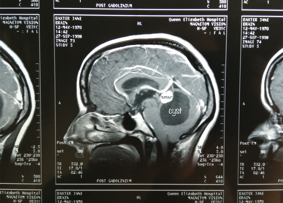 Close up of MRI scan showing Haemangioblastoma cyst and tumour in cerebellum with annotations