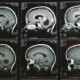 Photo of part of my MRI scan sheet showing the haemangioblastoma brain tumour and cycst in my cerebellum in 1998