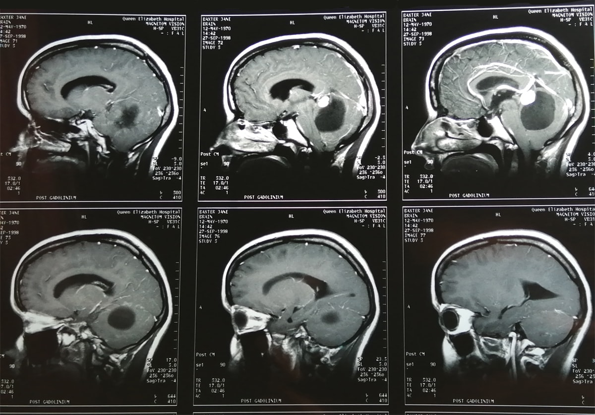 Photo of part of my MRI scan sheet showing the haemangioblastoma brain tumour and cycst in my cerebellum in 1998
