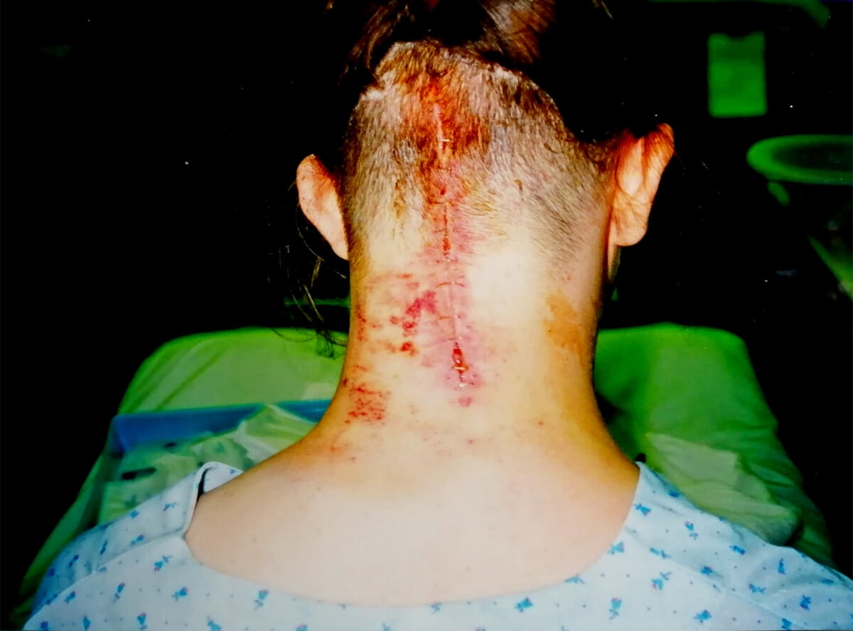 Photo showing the bruising on the back of my neck, with the wound site opening up where half the staples had been removed. The wound is about 6 inches long, vertically up the middle of my neck/ head. 