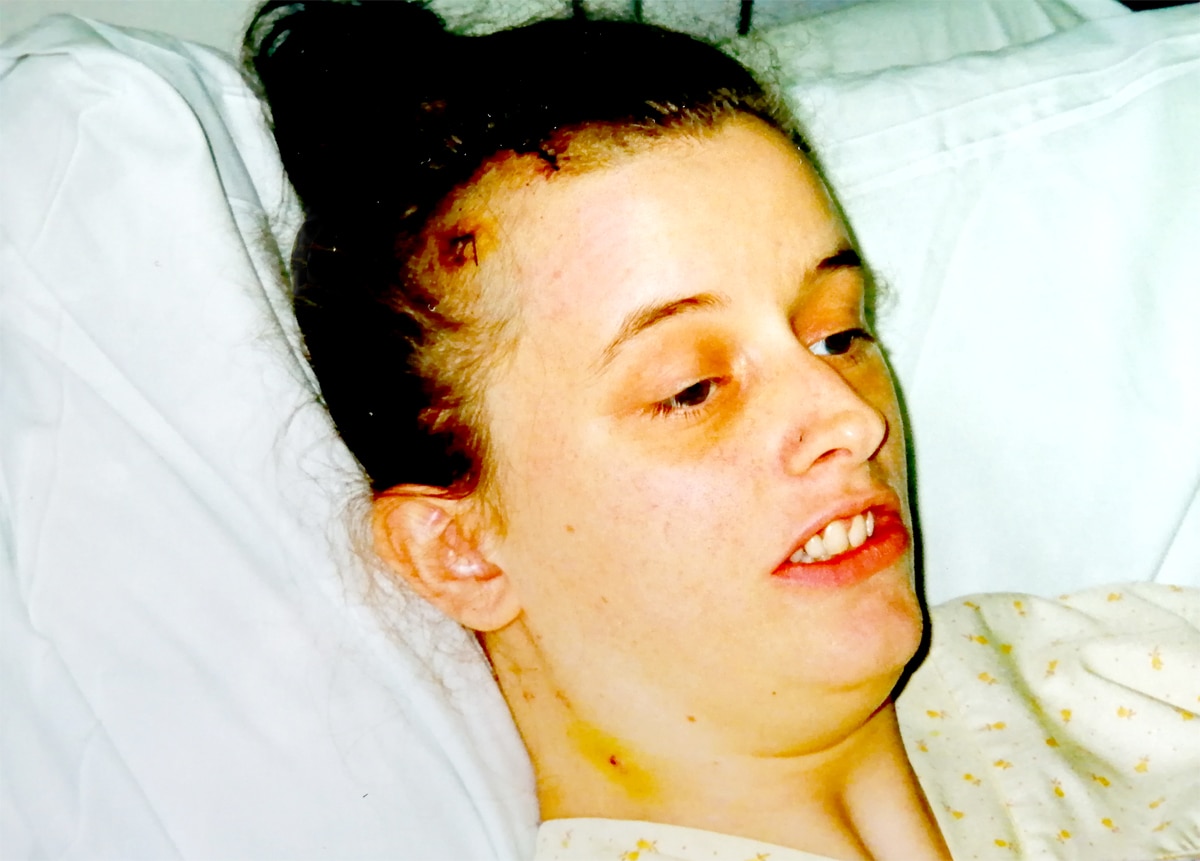 Stitches in head following cyst drain in head