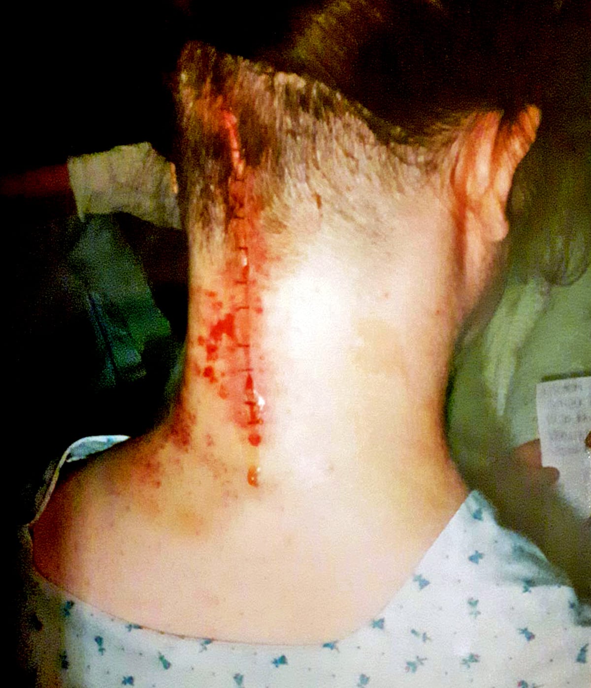 haemangioblastoma operation wound opening up after every second staple removed