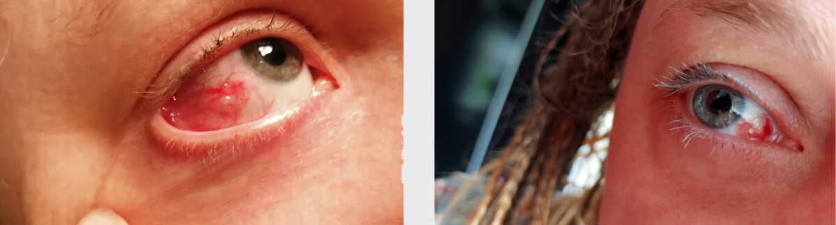 Photo of eye with subconjunctival haemorrhage bleed - red on the white sclera of eye