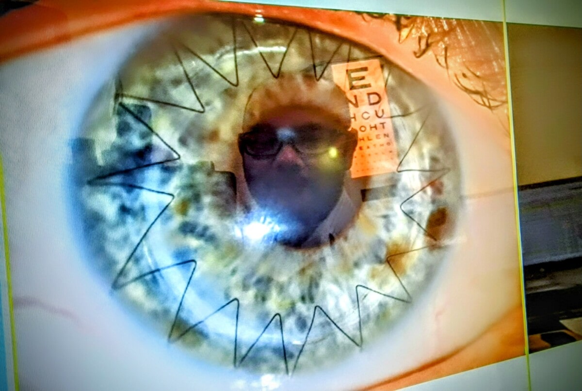 Photo taken on computer screen of close up crnea with zig zag stitches and a reflection of cornea specialist consultant, Dr Tint!